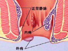 福州痔疮发作去哪个医院看好？