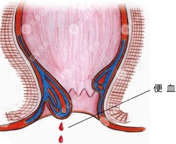 肛门出血,不疼